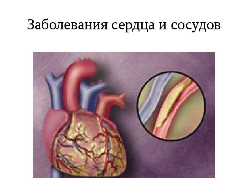 Заболевания сердца и сосудов
