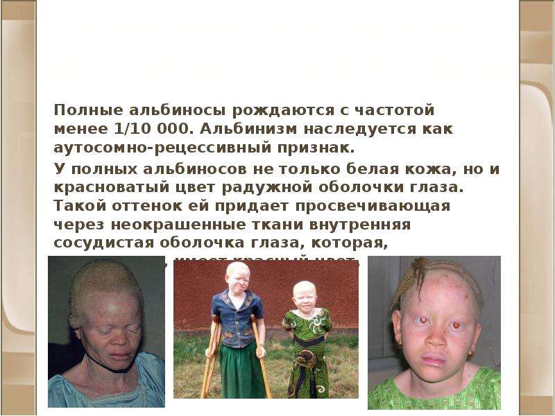 Альбинизм и другие нарушения