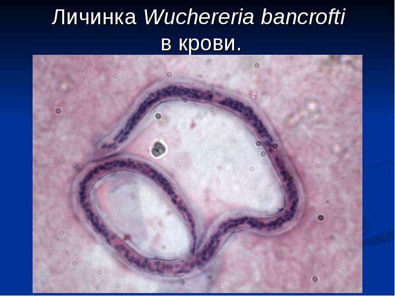Личинка Wuchereria bancrofti
