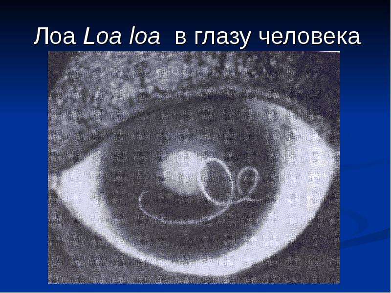 Лоа Loa loa в глазу человека