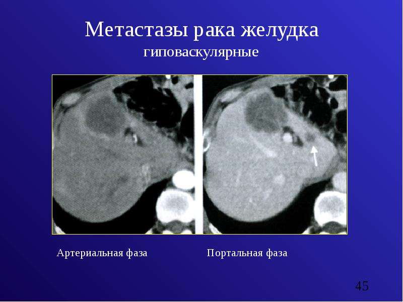 Метастазы рака желудка