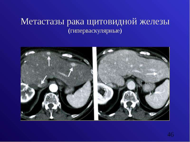 Метастазы рака щитовидной