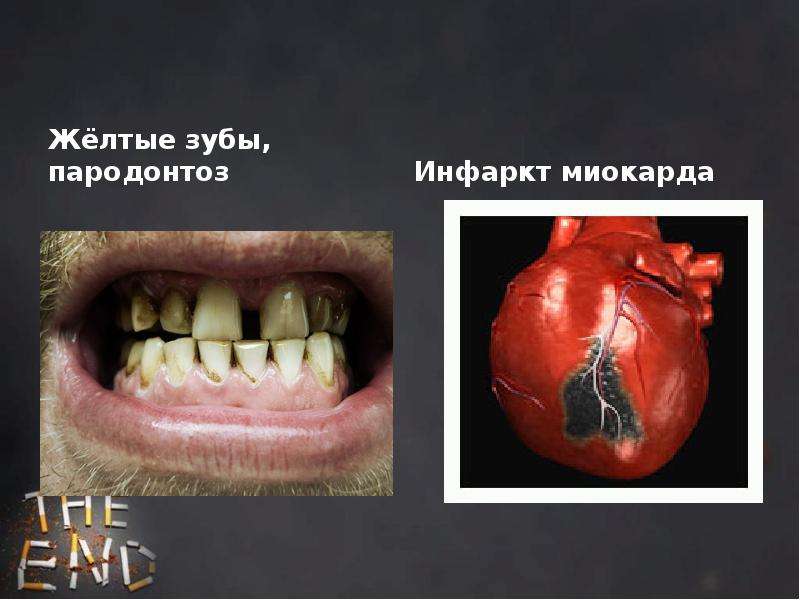 Жёлтые зубы, пародонтоз
