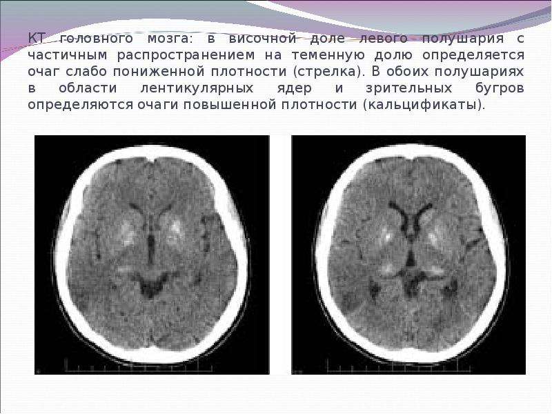 КТ головного мозга в височной