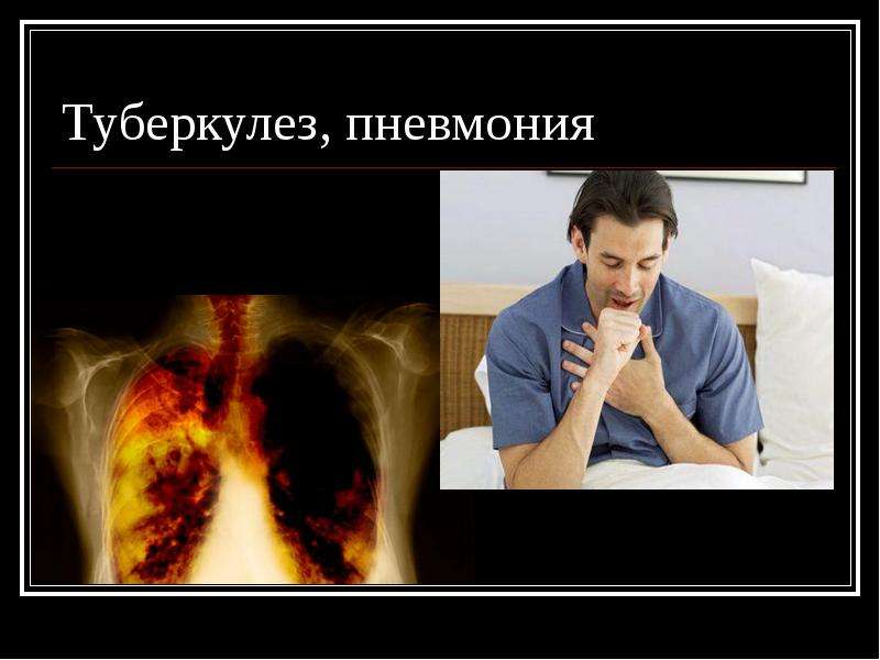 Туберкулез, пневмония