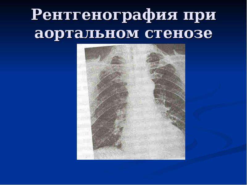 Рентгенография при аортальном