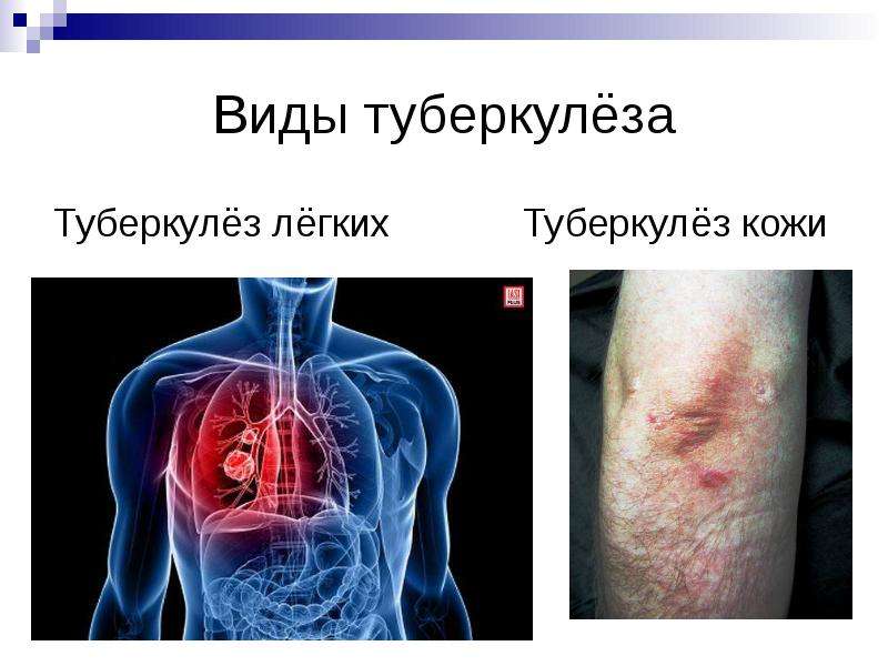 Виды туберкулёза Туберкулёз