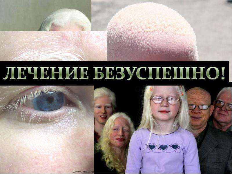 Альбинизм- нарушение