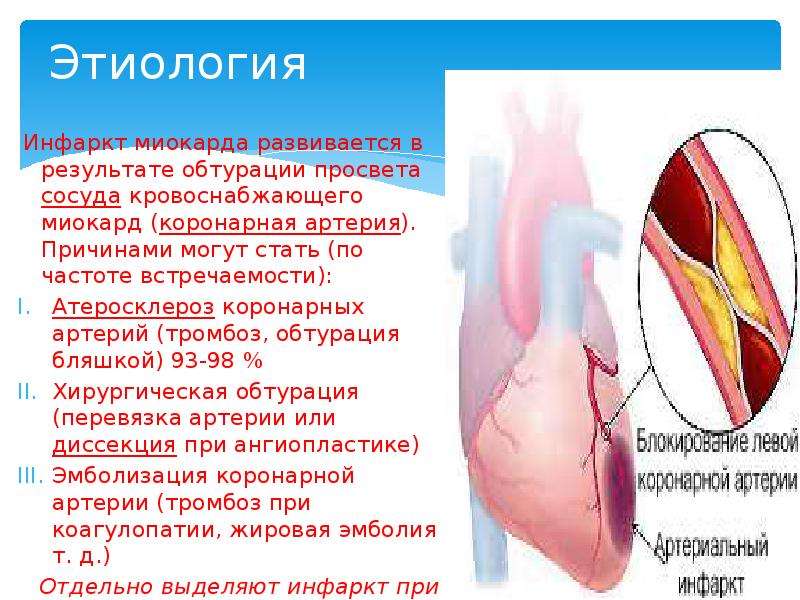 Этиология Инфаркт миокарда