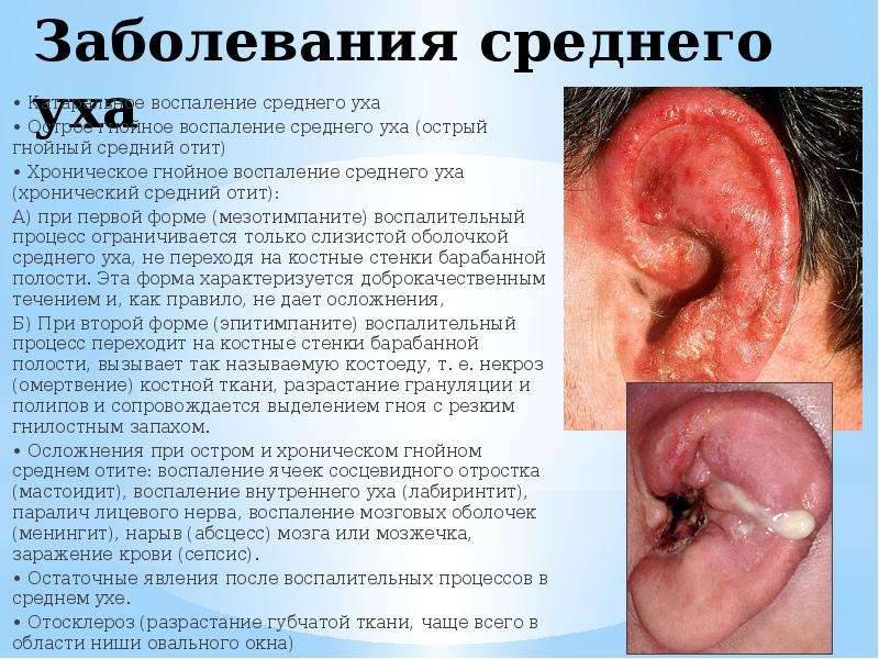 Заболевания среднего уха