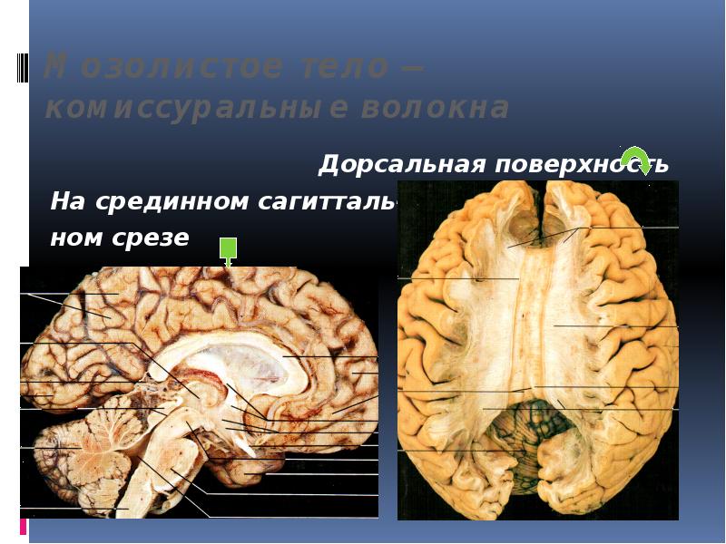 Мозолистое тело
