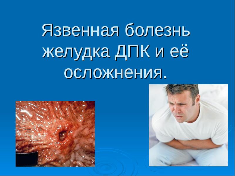 Презентация Язвенная болезнь желудка ДПК и её осложнения
