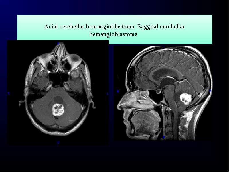 Axial cerebellar