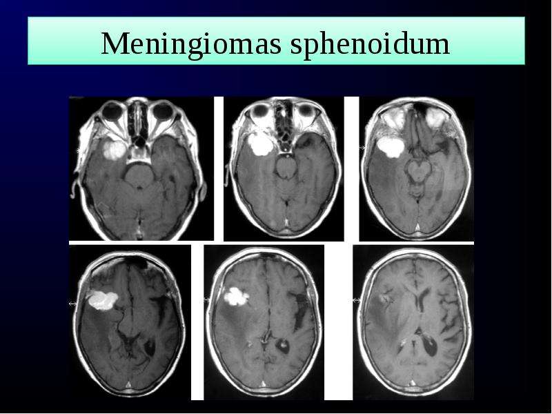 Meningiomas sphenoidum