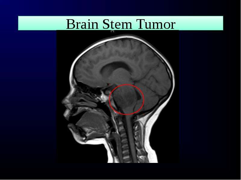 Brain Stem Tumor