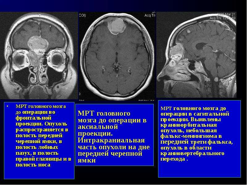 МРТ головного мозга до