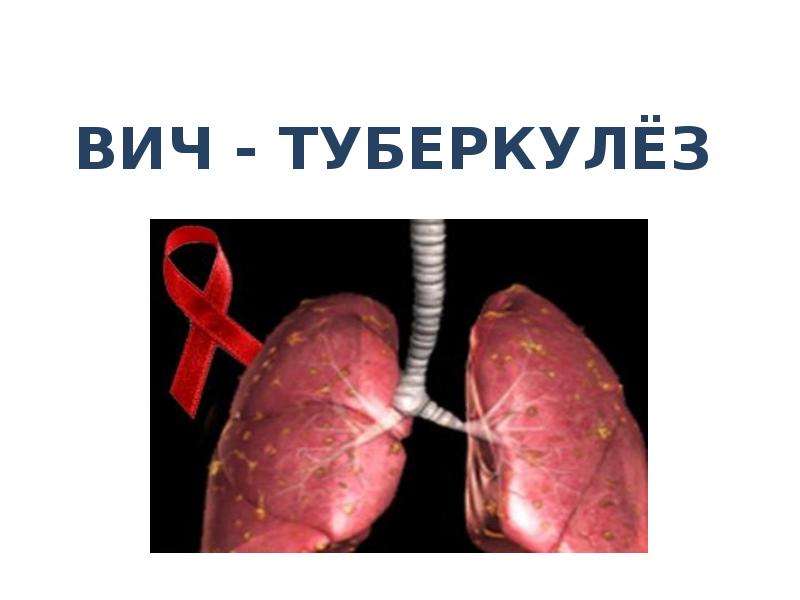 Презентация Туберкулёз и ВИЧ-инфекция