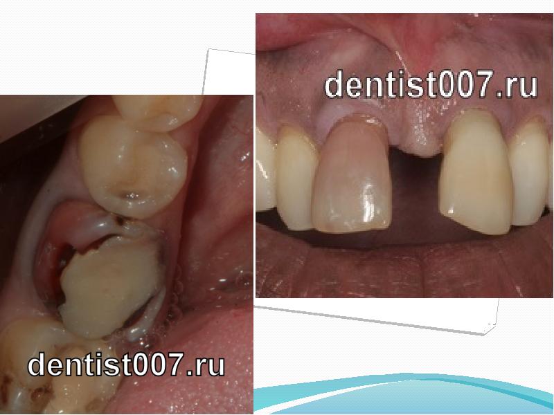 Дисколорит зуба после лечения