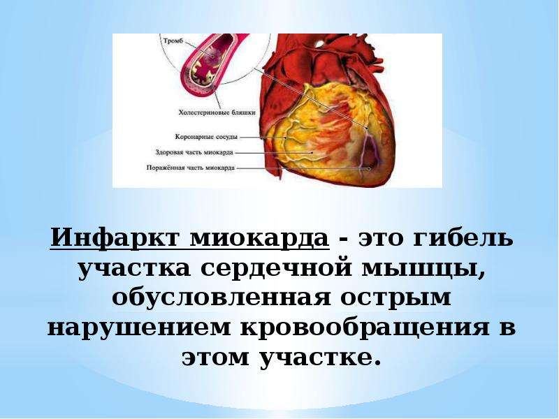 Инфаркт миокарда - это гибель