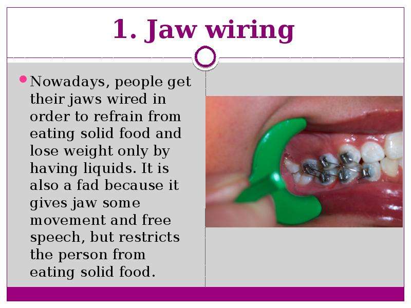 . Jaw wiring Nowadays, people